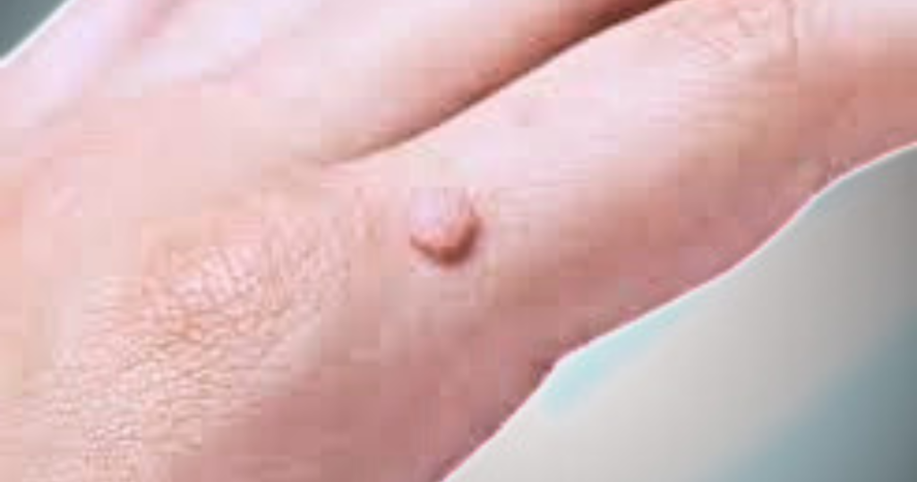 Skin Care Wart Removal Cream